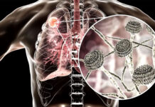 O femeie de 65 de ani este internată la Spitalul de Boli Infecţioase din Iaşi, cu suspiciunea de infecție cu ”ciupercă neagră”, o afecțiune gravă extrem de rară